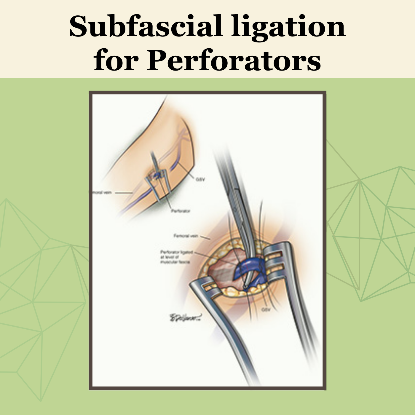 Subfascial Ligation For Perforators, Vascular Surgery, Sclerotherapy, Varicose Veins, Himatnagar, Mandsaur, Mirzapur, Surat, India. episode artwork