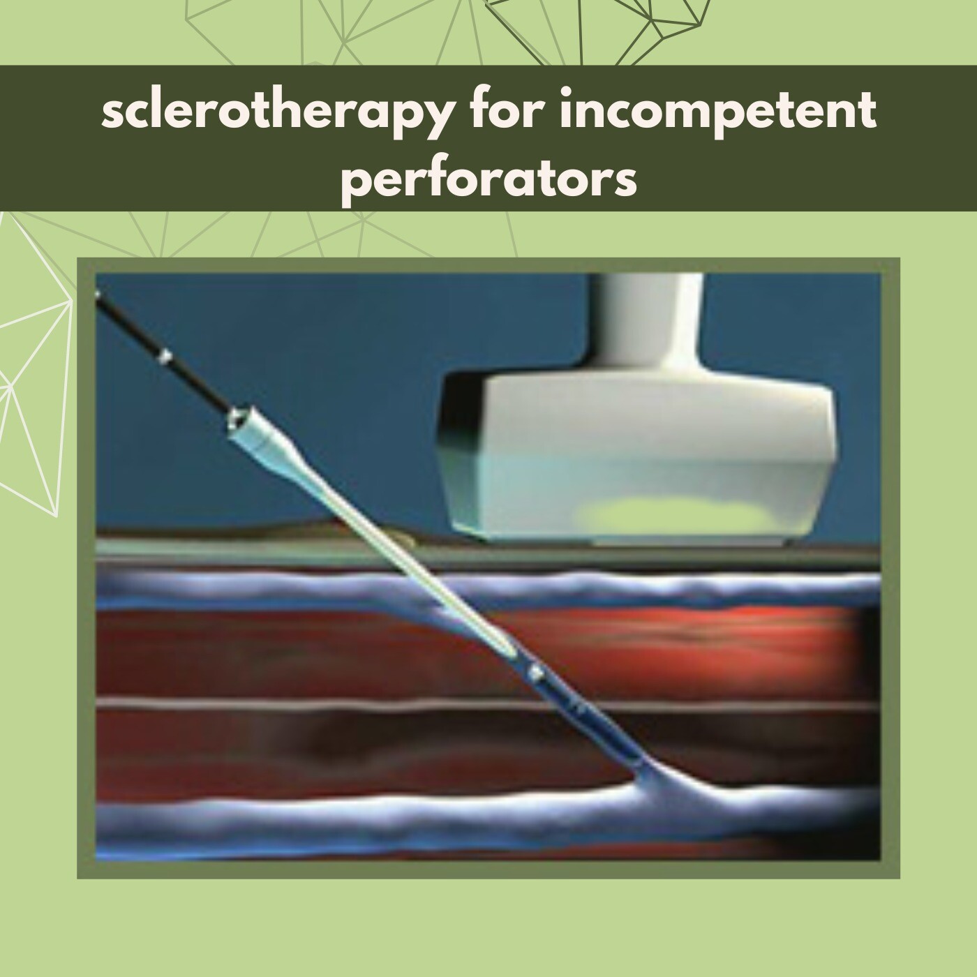 Sclerotherapy For Incompetent Perforators, Varicose Veins, Sclerotherapy Treatment, Mehsana, Solapur, Jalgaon, Surat, India. episode artwork