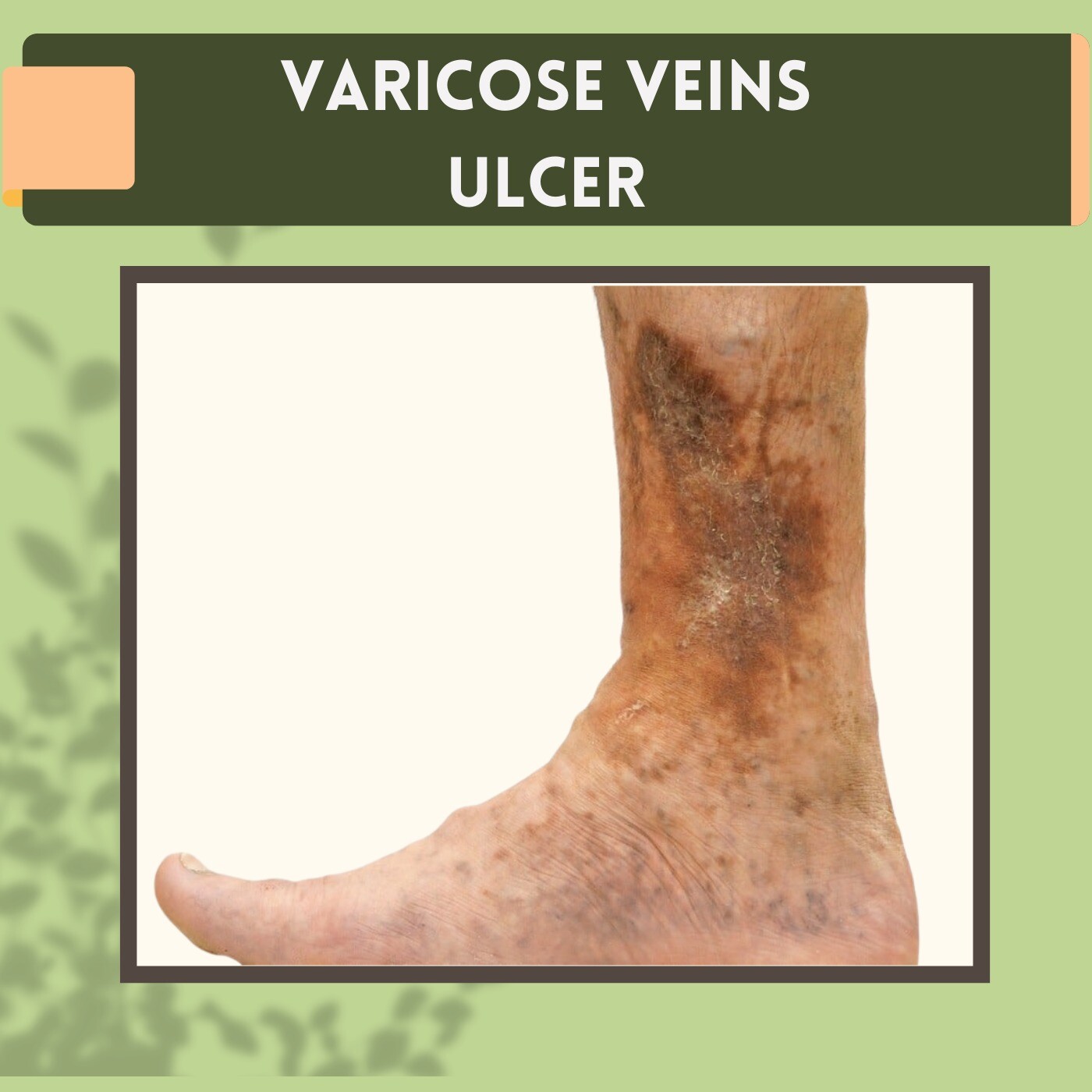Varicose Veins Ulcer, Leg Ulcers, Blood Clot, Gandhidham, Akola, Ratlam, Surat, India. episode artwork