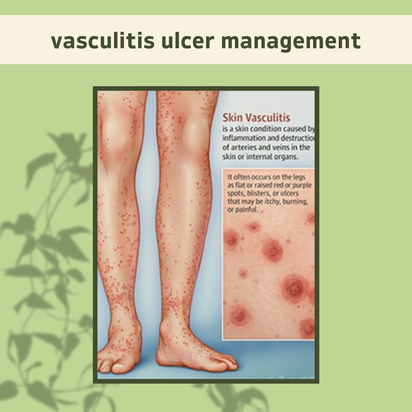 Vasculitis Ulcer Management, Chronic Ulcer, Biopsy, Blood Clot Problem, Porbander, Latur, Bhopal, Surat, Gujarat. episode artwork
