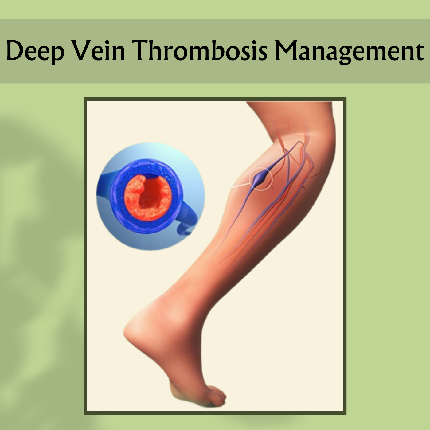 Deep Vein Thrombosis Management, Vascular Health, Blood Clot Management, Jamnagar, Akola, Jabalpur, Surat, Gujarat. episode artwork