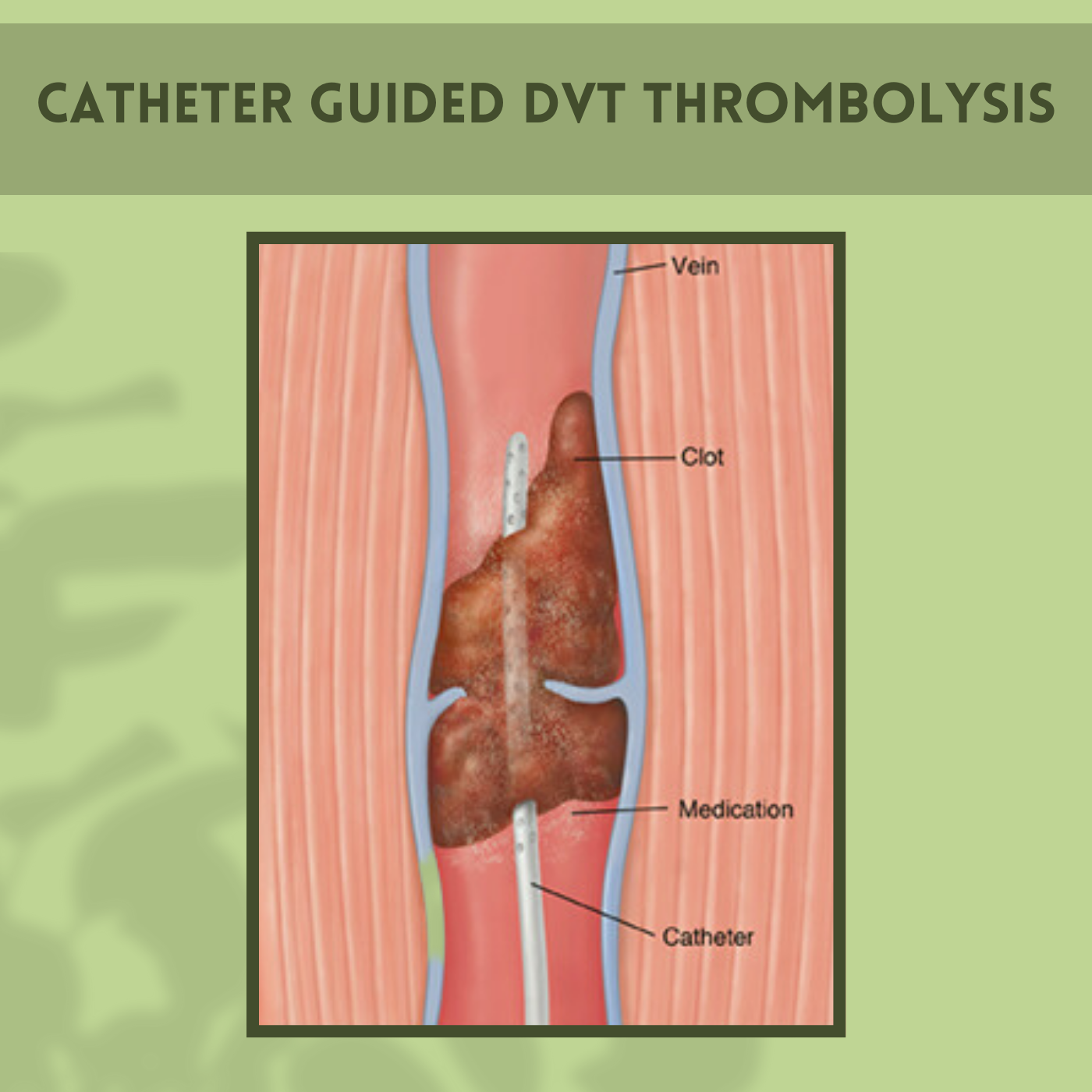 Catheter Guided DVT Thrombolysis, Clot-Busting Procedure, Thrombus Removal, Dwarka, Jalna, Raipur, Surat, Gujarat.