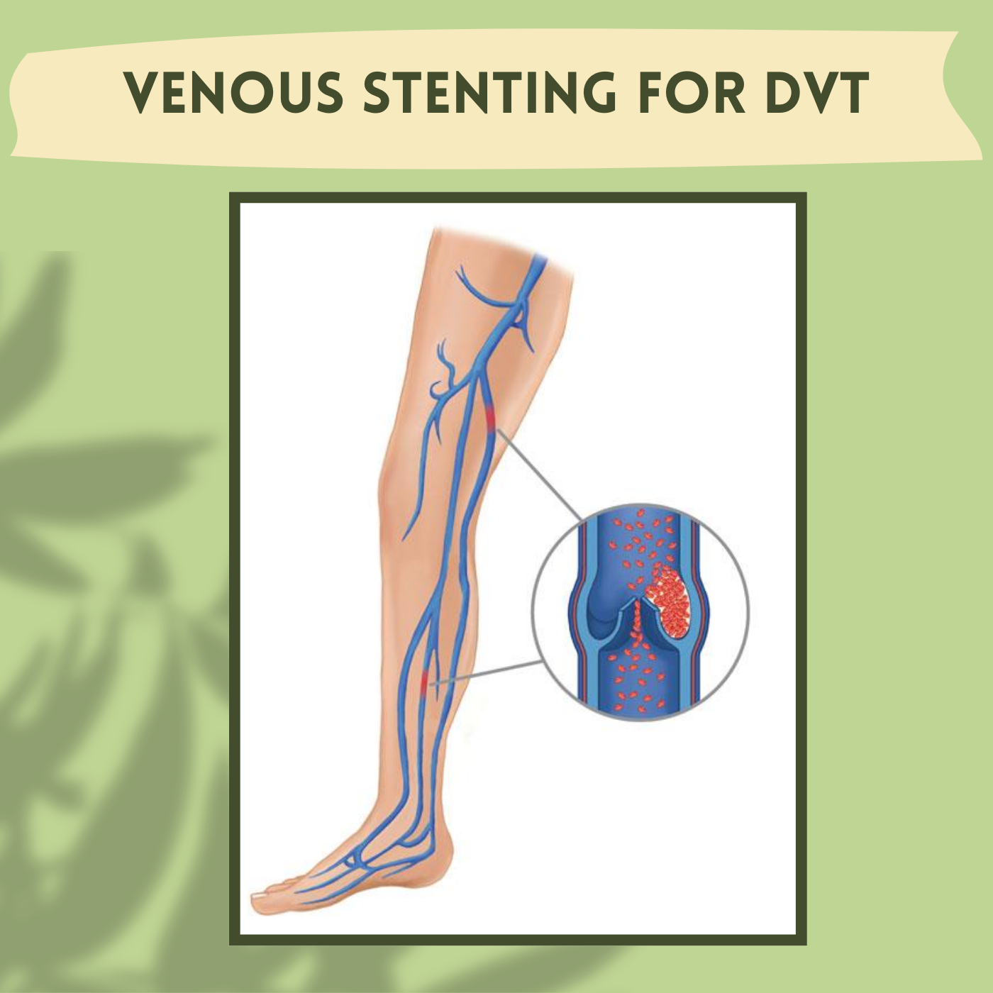 Venous Stenting For DVT, Stent Implantation, Thrombosis Management, Bhuj, Aurangabad, Jamshedpur, Surat, Gujarat. episode artwork