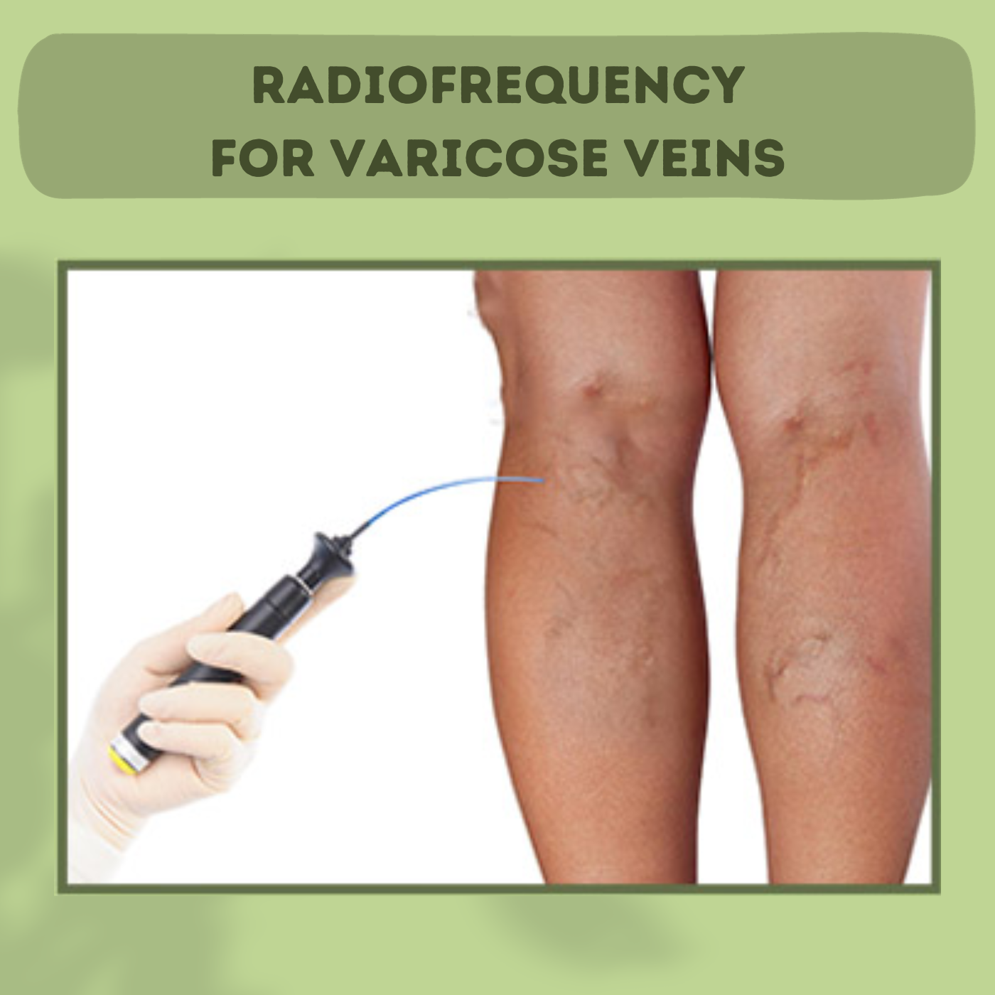 Radiofrequency For Varicose Veins, Laser Treatment, Vein Removal, Gandhidham, Pune, Hazaribagh, Surat, Gujarat.