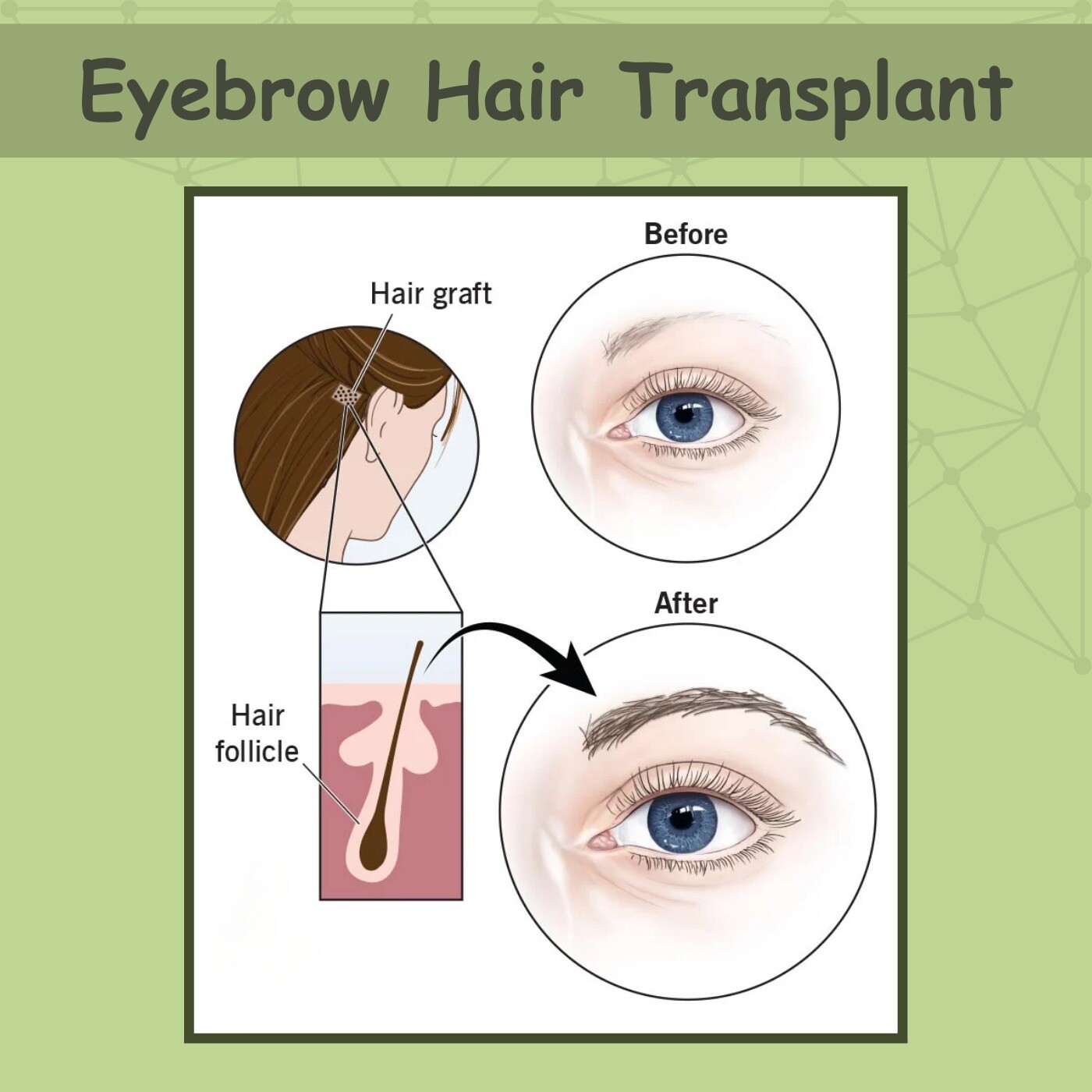Eyebrow Hair Transplant, Microblading, Natural Density, Gandhidham, Pune, Hazaribagh, Surat, Gujarat. episode artwork