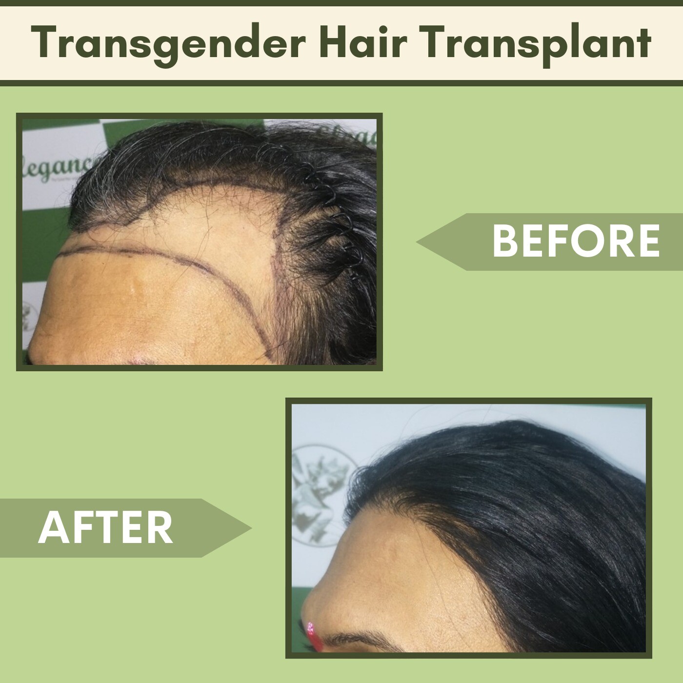 Transgender Hair Transplant, Beard Mustache Treatment, Sex Reassignment, Bhagalpur, Bhavnagar, Nashik, Surat, Gujarat. episode artwork