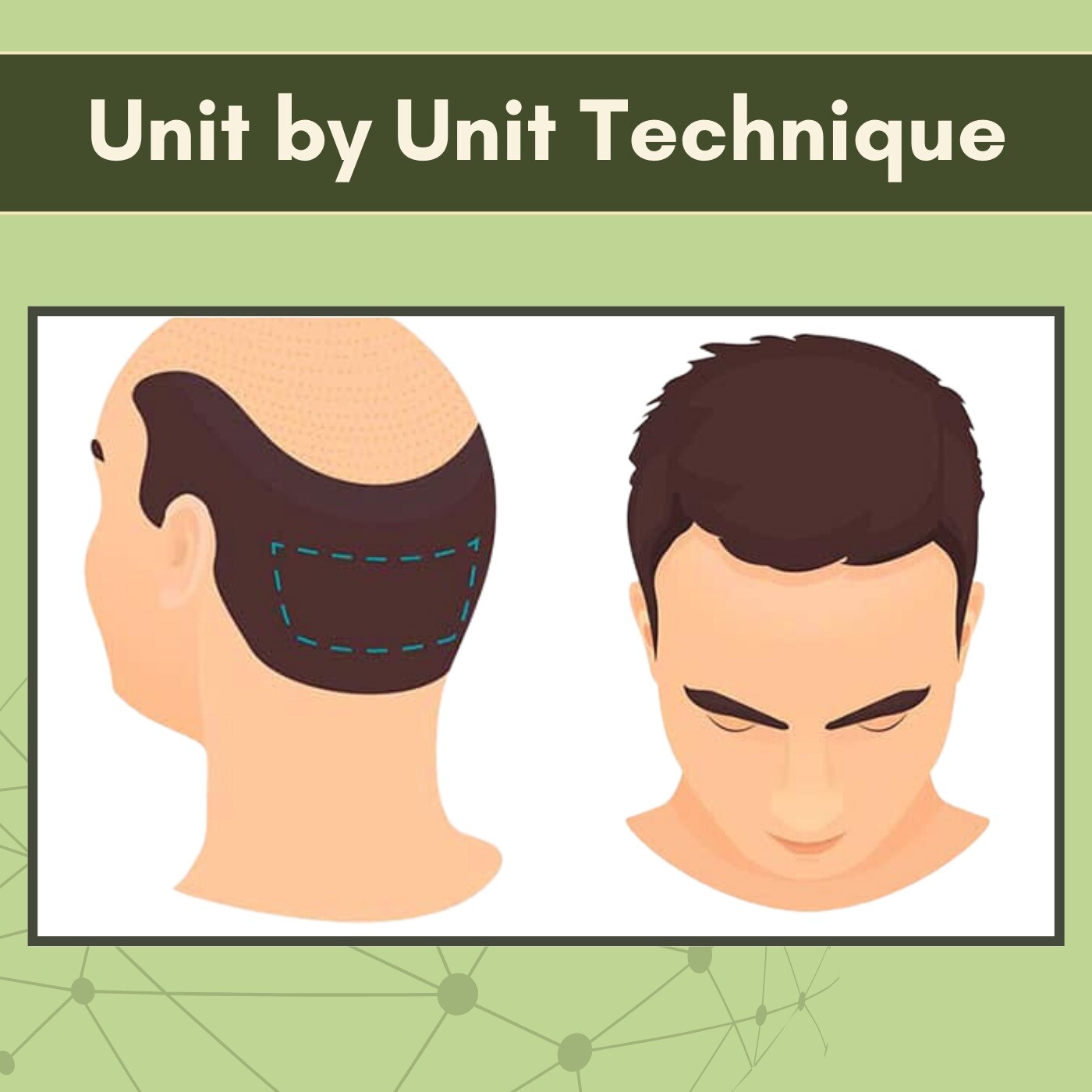 Unit By Unit Technique, Follicular Unit Hair Transplant, Healing Process, Mundra, Mumbai, Ambikapur, Surat, Gujarat.