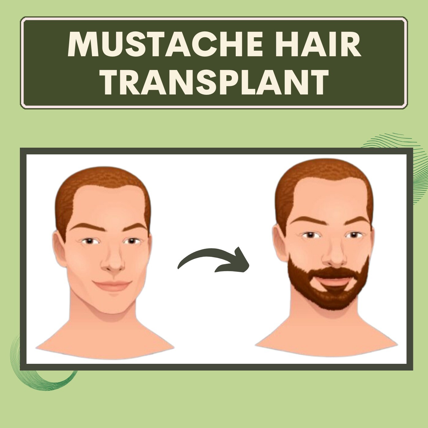 Mustache Hair Transplant, FUT & FUE Treatemnt, Anesthesia Procedure, Ahmednagar, Bhuj, Ratlam, Surat, Gujarat. episode artwork