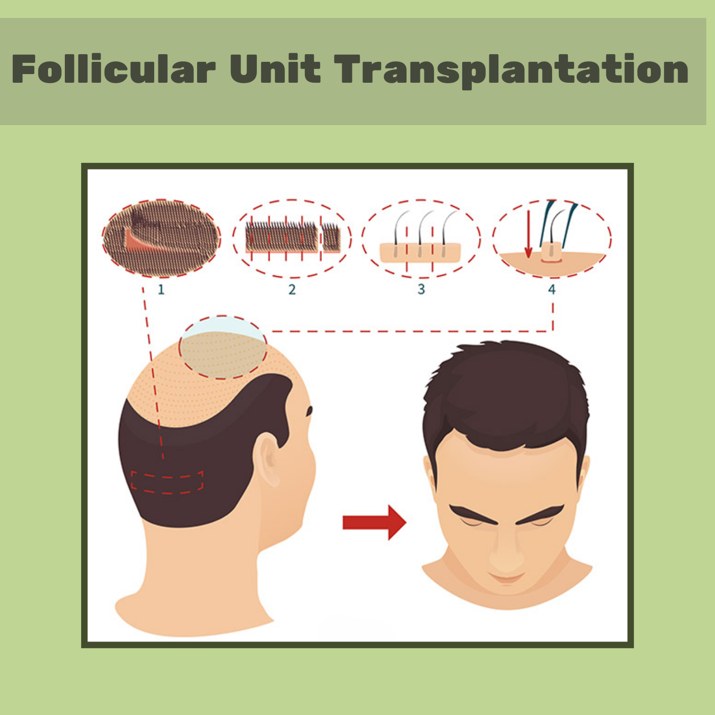 Follicular Unit Transplantation, Reduce Strip, Minimum Scaring, Latur, Junagad, Jaipur, Surat, Gujarat. episode artwork