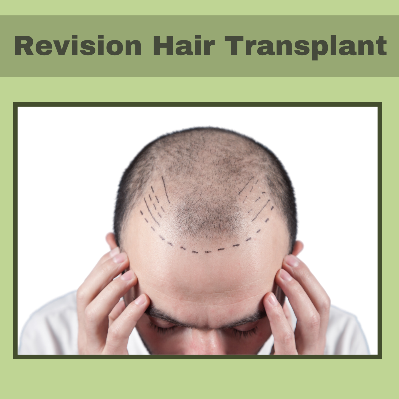 Revision Hair Transplant, Hairline Revision, Hair Graft Correction, Mumbai, Patna, Udaipur, Surat, India. episode artwork