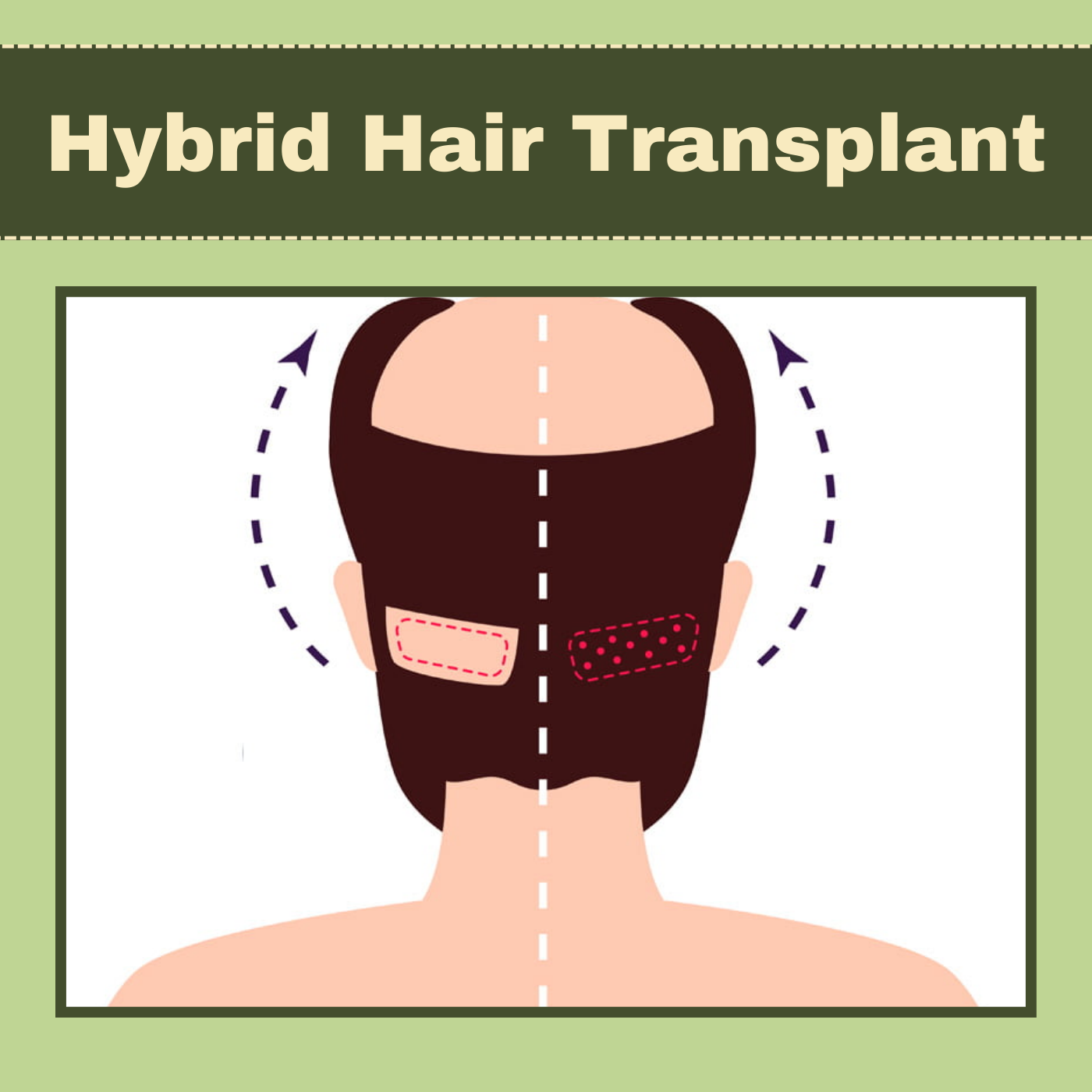 Hybrid Hair Transplant, FUE + FUT Hybrid Technique, Hair Grafting, Nashik, Himatnagar, Bhagalpur, Surat, India. episode artwork
