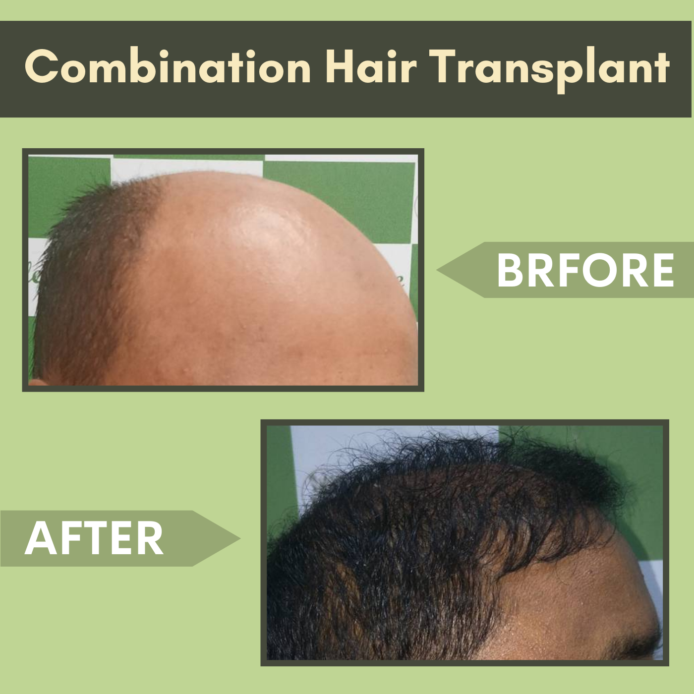 Combination Hair Transplant, Beard Hair Transplant, FUT, FUE, Hair Restoration, Mumbai, Mehsana, Darbhanga, Surat, India. episode artwork