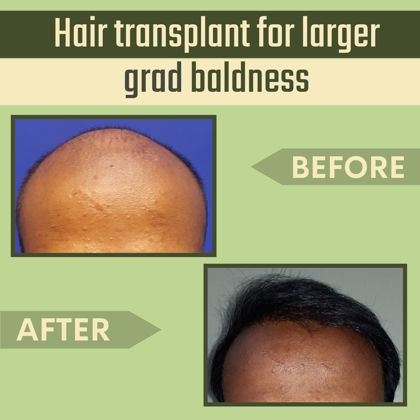 Hair Transplant For Larger Grad Baldness, FUE & FUT, Hair Density, Mundra, Patna, Aurangabad, Surat, India.