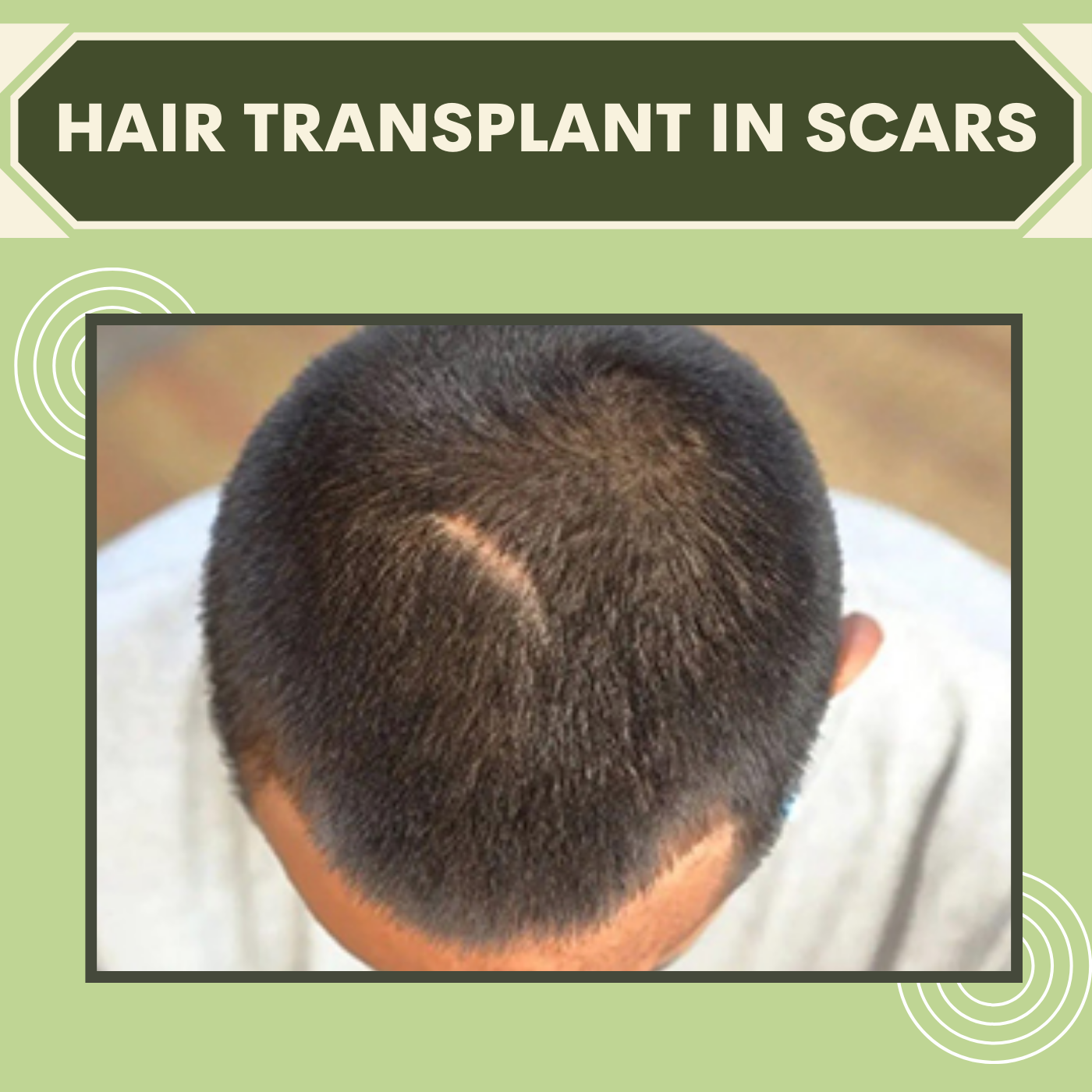 Hair Transplant In Scars, Hair Density, Scarred Hairline Repair, Gandhidham, Prayagraj, Ahmednagar, Surat, India. episode artwork