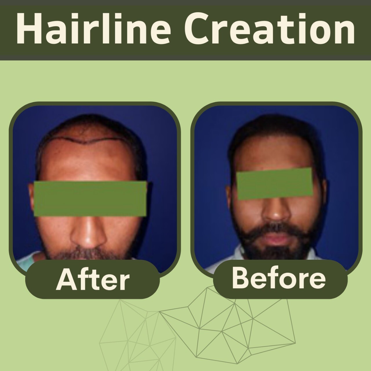 Hairline Creation, Hair Grafts, Natural Hairline, Latur, Bhagalpur, Pune, Surat, India. episode artwork