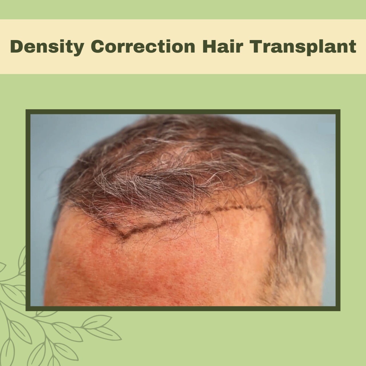 Density Correction Hair Transplant, Hair Graft, Hairline Density, Nashik, junagad, Ambikapur, Surat, India. episode artwork