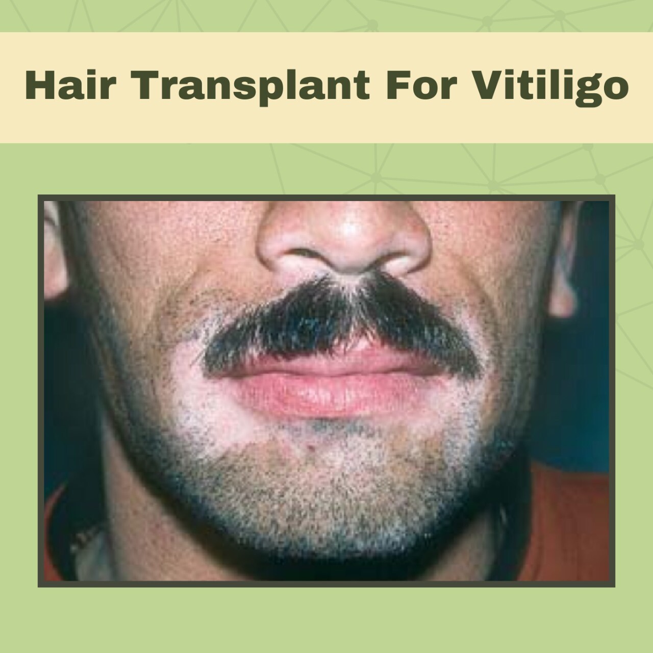Hair Transplant For Vitiligo, Skin Grafting Procedure, FUE Treatment, Pune, Porbander, Mandsaur, Surat, India. episode artwork