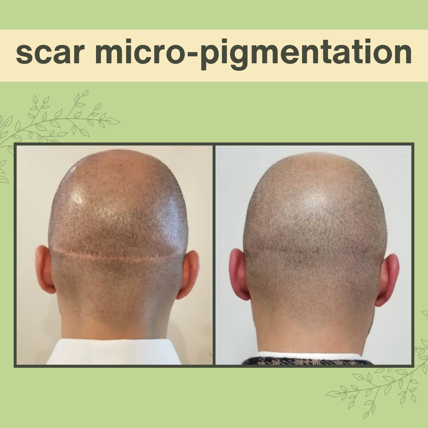Scar Micro-Pigmentation, Scalp Micropigmentation, Scalp Tattooing, Kanpur, Jaipur, Patna, Surat, India. episode artwork