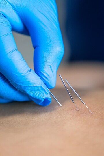 How Acupuncture Can Improve Your Health episode artwork
