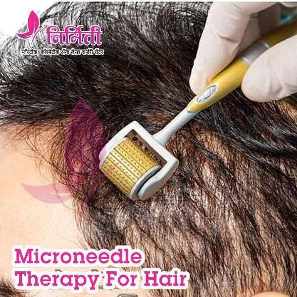 Microneedle Therapy For Hair episode artwork