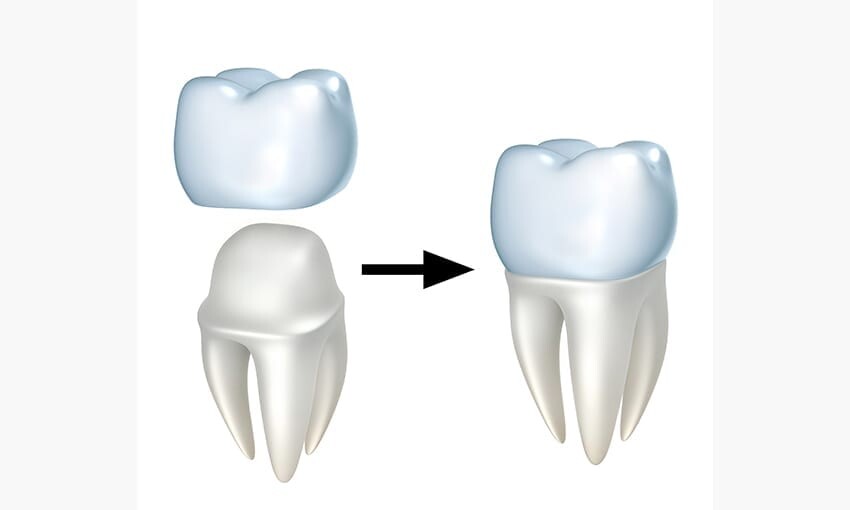 Restorative Dentistry: Exploring Dental Crowns in Victor Harbor episode artwork