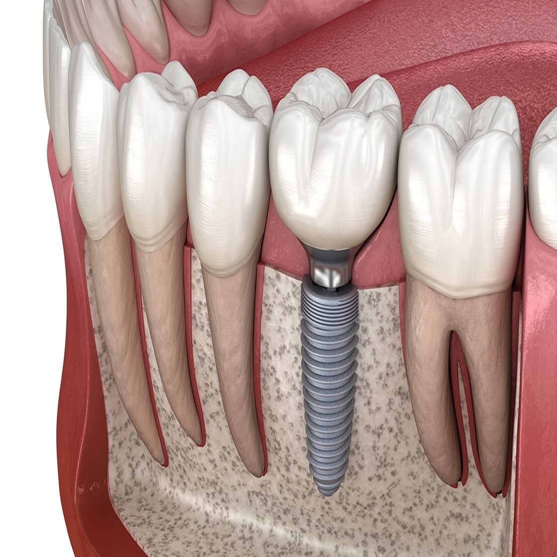 From Missing Teeth to New Smiles: The Power of Dental Implants episode artwork