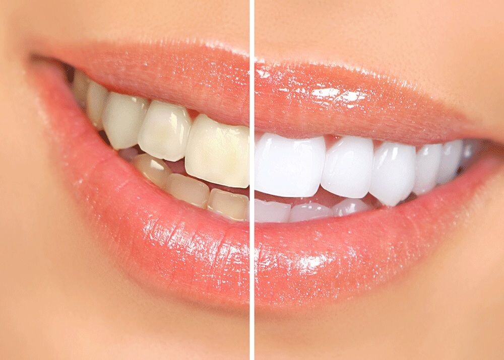 Teeth Whitening: Exploring the Best Methods for a Brighter Smile episode artwork