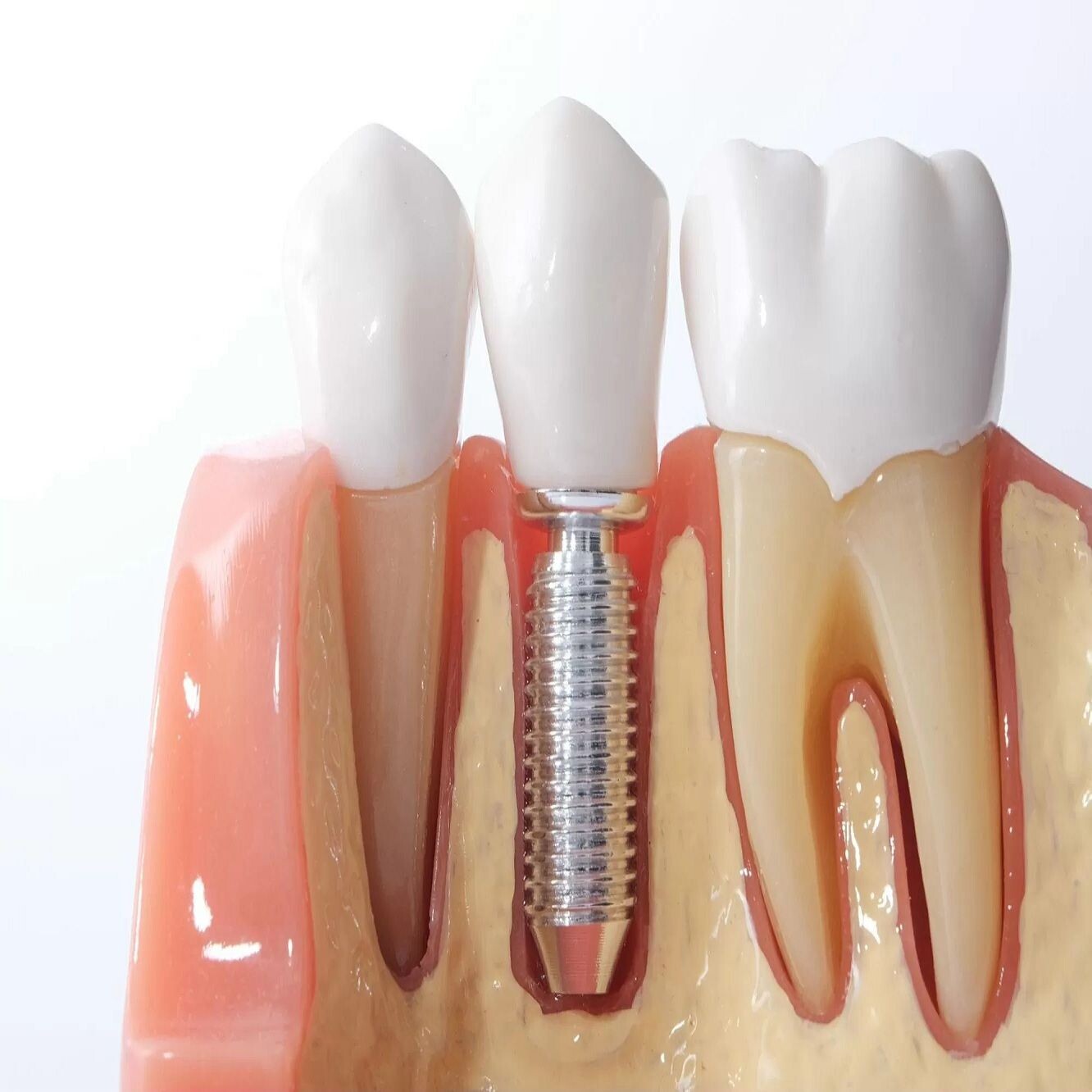 Behind the Smile: Dental Implants from a Dentist’s Perspective episode artwork