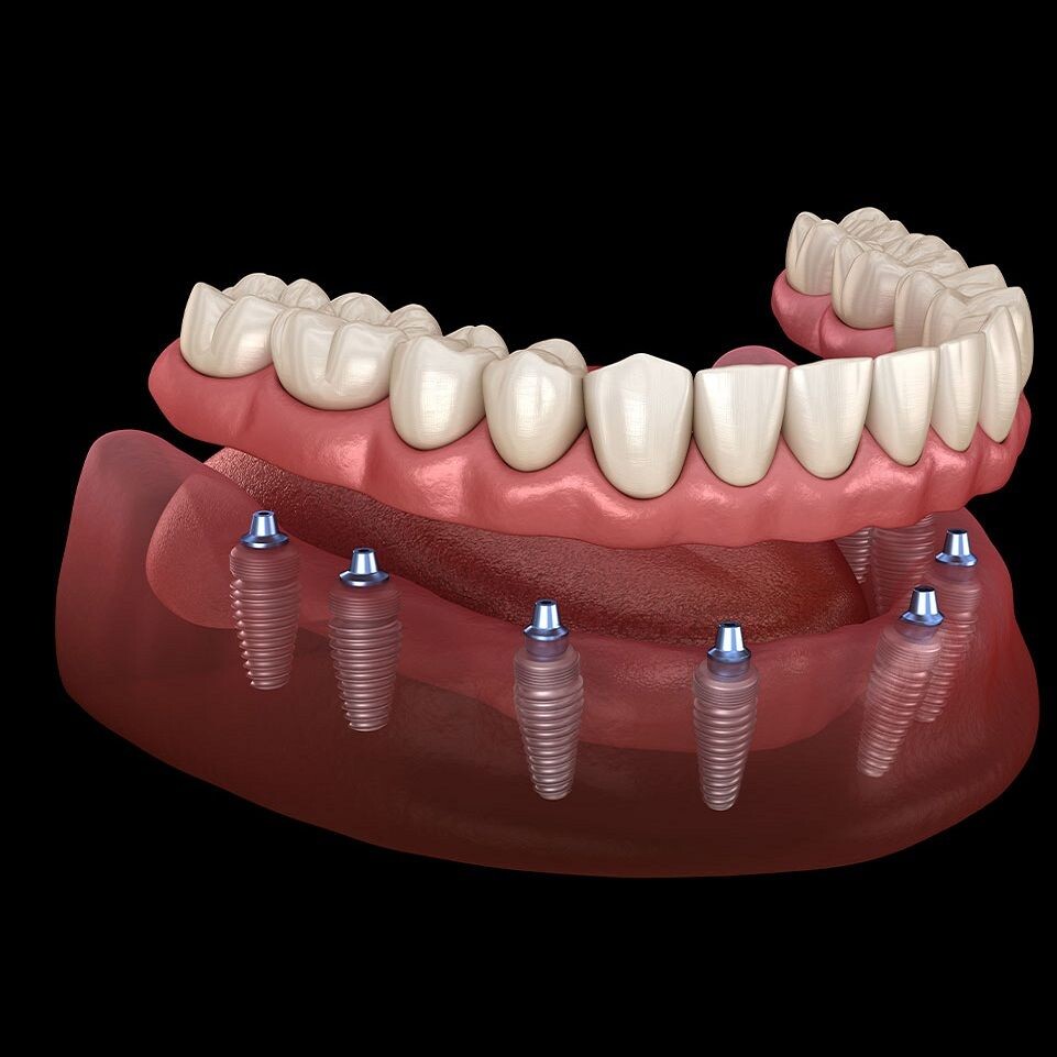 Dental Implants for Long-Term Oral Health episode artwork