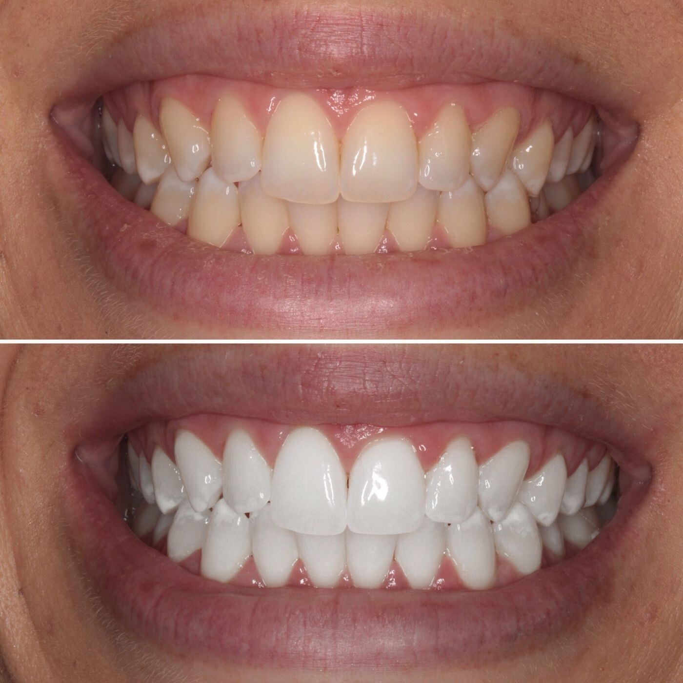 Teeth Whitening: How to Achieve a Brighter Smile Safely episode artwork