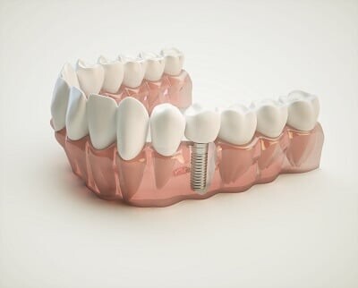 Dental Implants in Whyalla: Transforming Smiles and Lives episode artwork