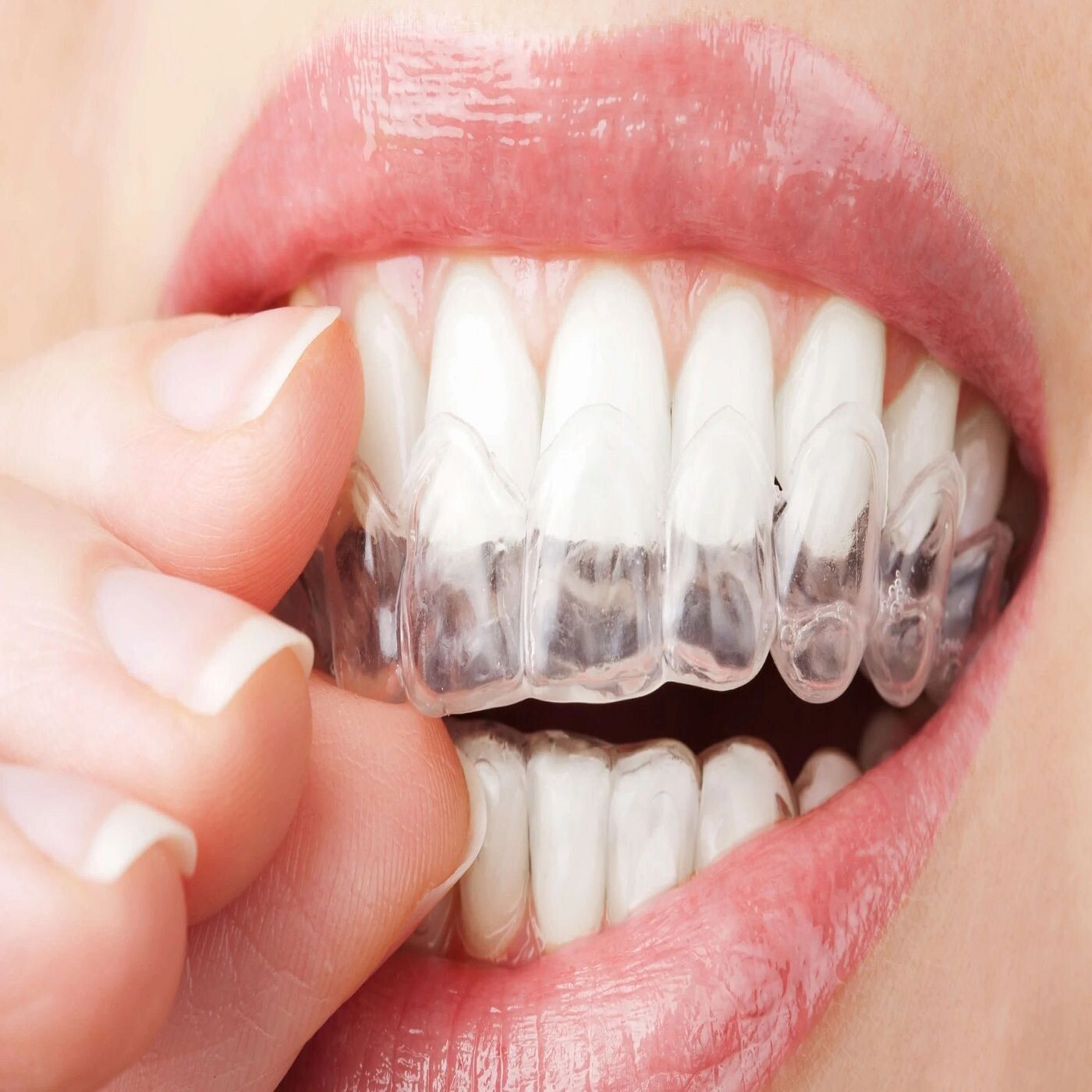 Invisalign in Whyalla: The Clear Choice for a Perfect Smile episode artwork
