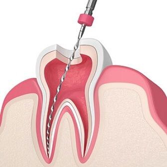 Root Canal Myths Busted: What You Really Need to Know? episode artwork