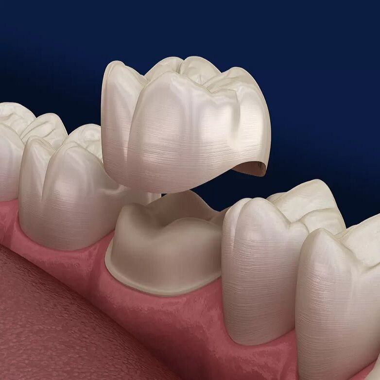 The Power of a Dental Crown: Restoring Your Smile episode artwork