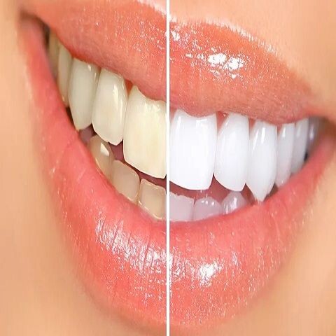 Teeth Whitening Treatments: Which One Works Best? episode artwork