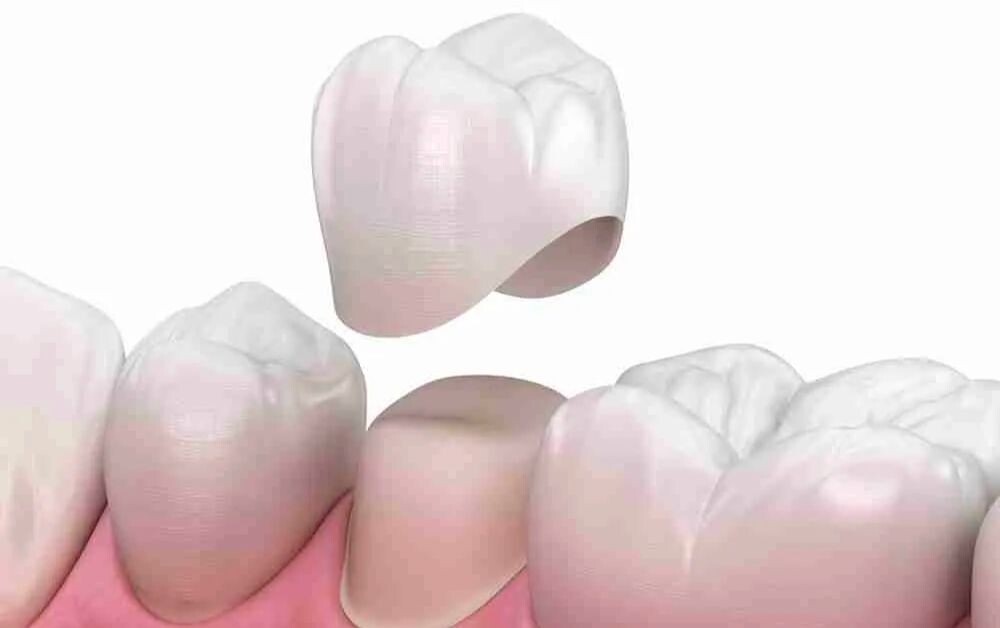 Dental Crown: How to Choose the Right One for Your Smile episode artwork