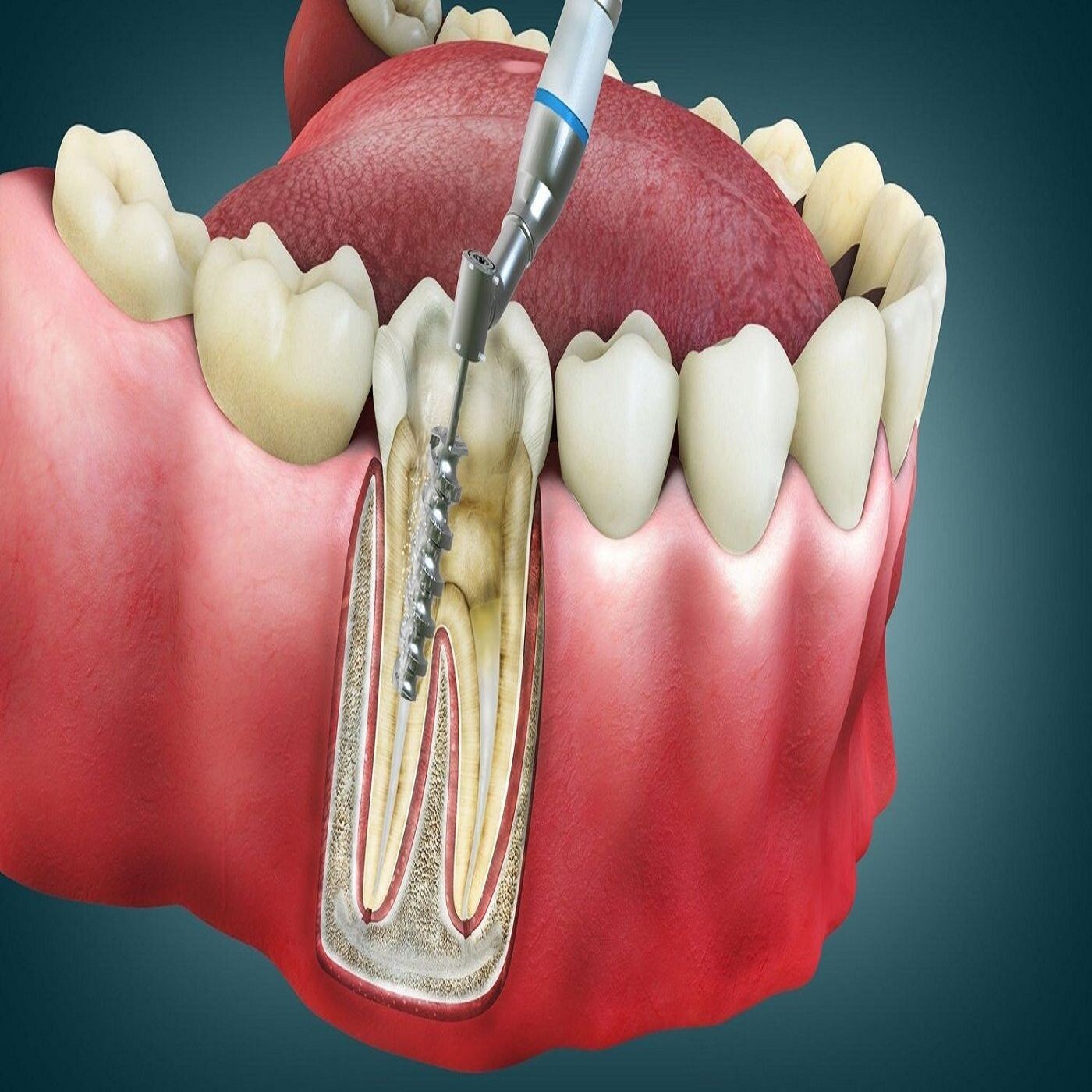 Pain-Free Root Canal in Mitcham episode artwork