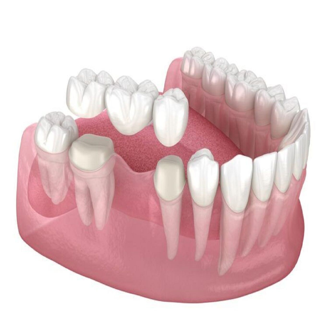 Dental Crown Cost in Mitcham episode artwork