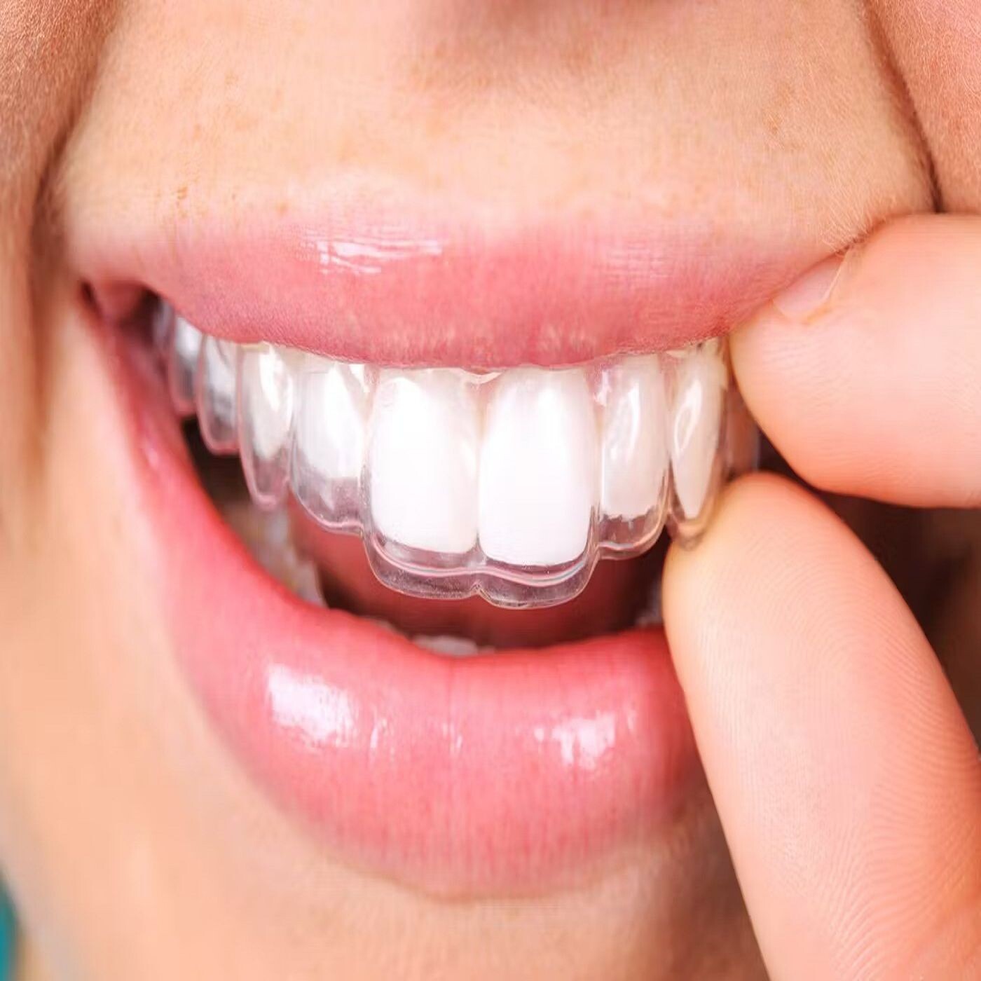 Straighten Your Teeth with Invisalign in Mitcham episode artwork