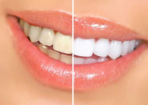 Teeth Whitening Dentist in Mitcham: Brightening Your Smile episode artwork