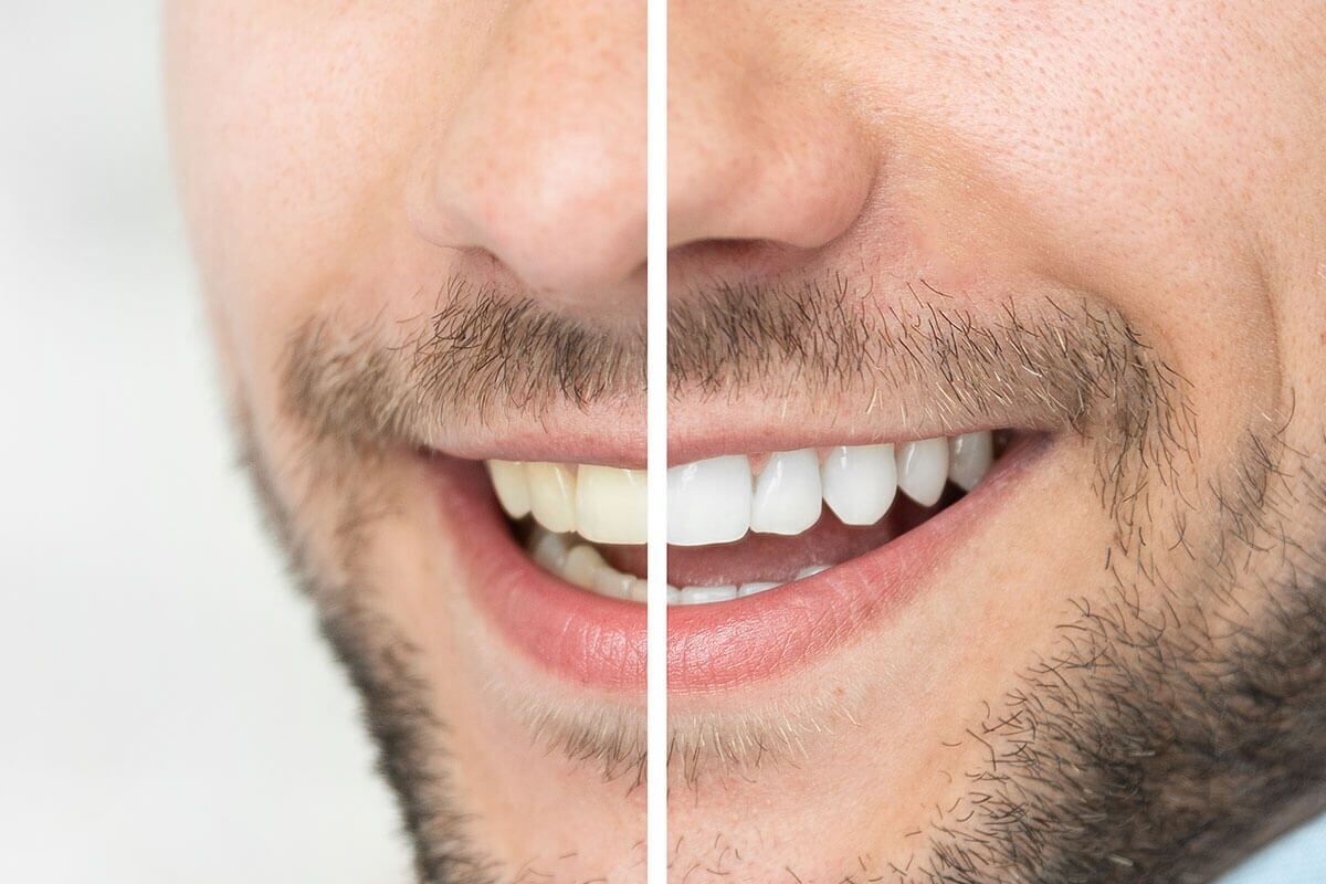 Teeth Whitening: Secrets to a Brighter, Whiter Smile episode artwork