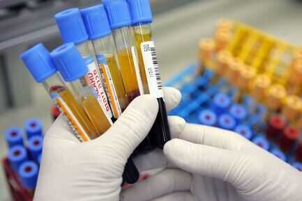 Understanding the HbA1c Test and Its Importance: A Guide for Mohali Residents