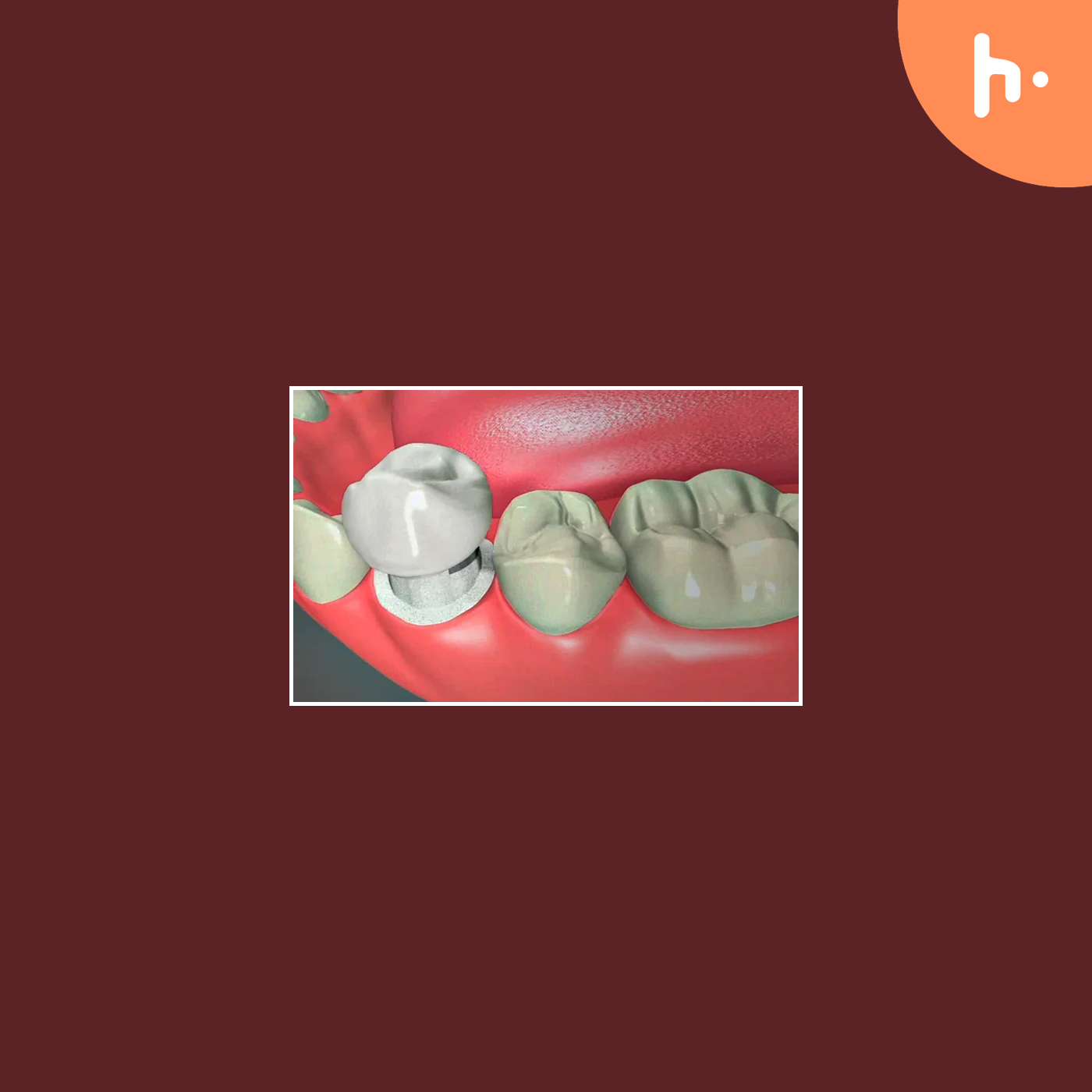 5 Signs It’s Time to Consider Dental Crowns in Newark cover