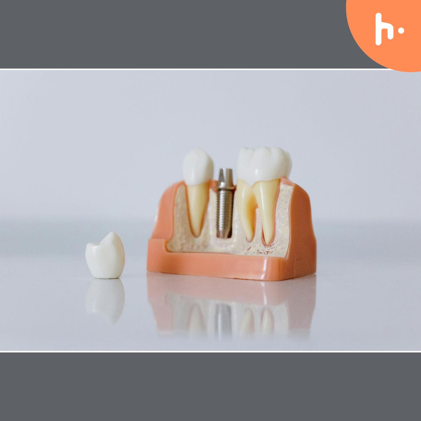 Smile Bright Again with Dental Implants in Washington podcast artwork