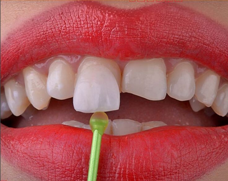 Porcelain Veneers Cost in India: A Comprehensive Guide episode artwork