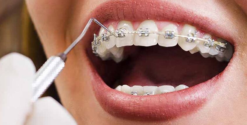 Affordable Dental Braces in Chandigarh: Costs and Options episode artwork
