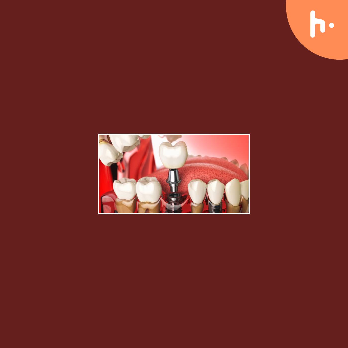 Top 5 Nutrition Tips After Dental Implants in Washington