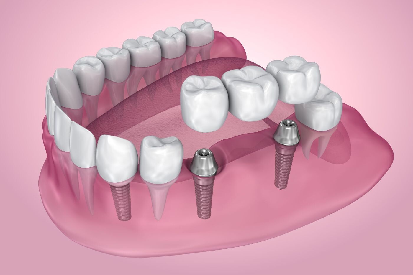What’s the Difference Between Dental Bridges and Implants in Montclair episode artwork